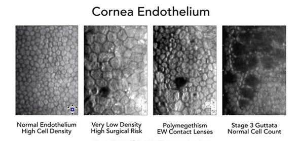 cornea-endothelium